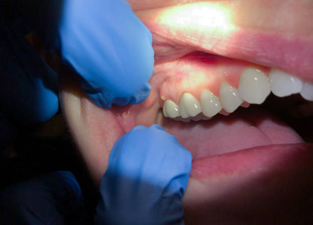 Best Emergency Dental Care for Broken or Chipped Teeth in Wauconda, IL